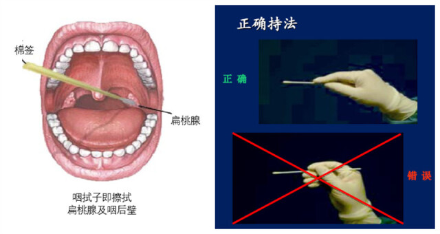 扩大筛查力度:核酸检测仍是金标准,采样质量是关键