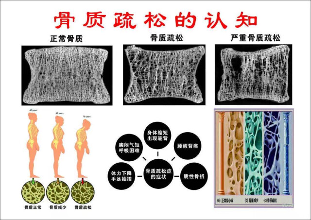 警惕骨质疏松,骨密度筛查很重要!