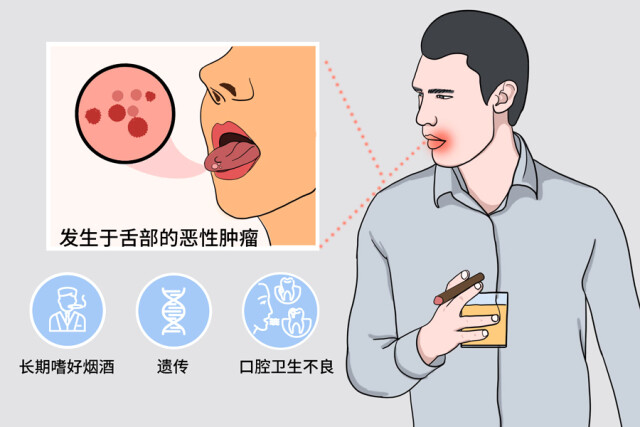 舌癌早期症状表现为黏膜表面边界清楚,范围固定,颜色异常,明显感觉