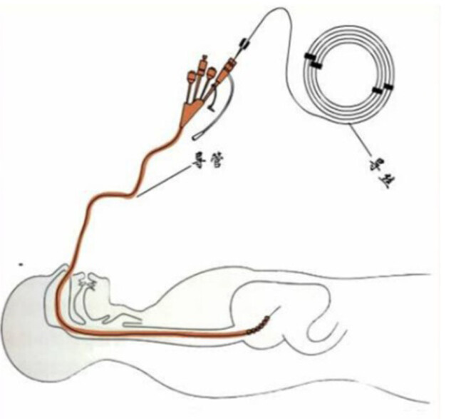 从"肠"计议:疏通梗阻解胀痛,一根导管显奇效