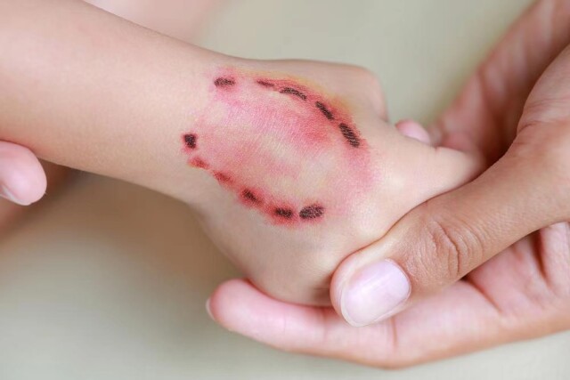 ii级伤口:皮肤被动物轻度咬伤,或者无出血的轻微抓伤及擦伤,或破损