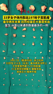 33岁女子体内取出197枚子宫肌瘤