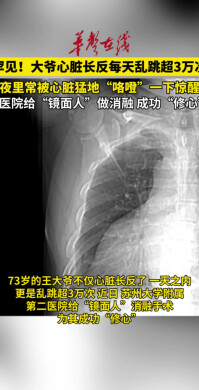 73岁大爷心脏长反了，每天乱跳超3万次