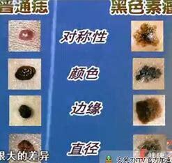 色素痣大多“纯良无害”  但最怕一件事
