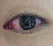 眼睛红了  竟是关节炎惹的祸