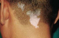 困扰患者终生的白癜风会不会传染？