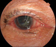 “隐形眼镜”佩戴8年忘记取出，老人险失明