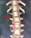 贪玩一“跳”，20岁男子腰椎骨折险瘫痪