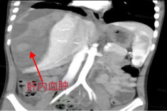 当心！这个器官特别“脆”，今年患儿有增多趋势