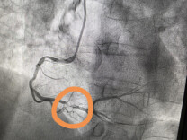 身体乏力竟是心梗征兆，72分钟抢回一命
