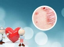 叫“癣”非真癣 没有传染性治疗银屑病越来越有“靶”握