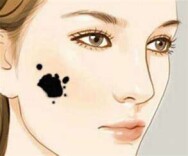 健康中国  |  黑痣发生五种改变需警惕