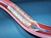支架能救命 但不能治病 患心血管疾病要重视心脏康复