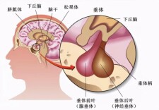 男子头痛视物模糊2个月辗转就医，竟是“垂体瘤卒中”在“捣乱”