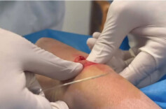 湘西中医·医星闪耀|陈凌帆：湘西“一针”，巧手施治