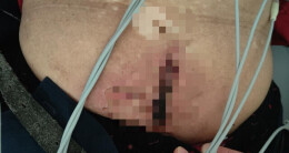 贴身使用暖宝宝，八旬老人皮肤二度烫伤