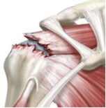 肩痛≠肩周炎，也可能是肩袖损伤