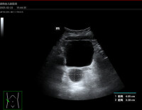 警惕！6岁女童来月经？可能是肿瘤或囊肿所致