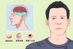 什么？感冒后持续流清涕，流的可能是脑脊液