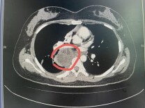 24岁女孩胸口长“巨石”，原来是这种病引起！