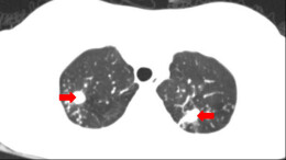 花季女孩患上皮肤怪病，原是感染皮肤结核