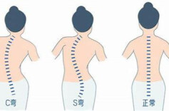 脊柱侧弯莫忽视，一起扶正“小树苗”！