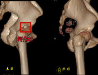 肌肉里面长“石头”？原是髋部钙化性肌腱炎