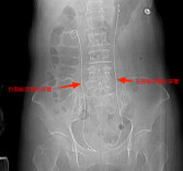 从腰痛到休克仅24小时！专家提醒这种常见病死亡率高达40%