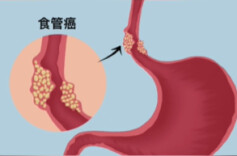 牢记！“三感一痛”是这类肿瘤的早期典型症状