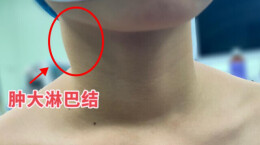 甲状腺癌也会侵害孩子！小心脖子上这种“小疙瘩”......
