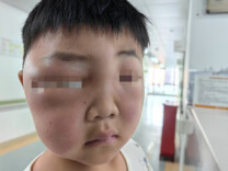 避免搔抓！这个病进入高发季，好发于儿童