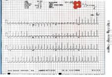 突发突止的心慌头晕，可能是心脏在“求救”