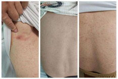 虫咬后高烧不止！湘雅常德医院救治罕见恙虫病感染患者