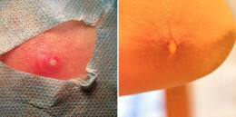 皮肤里取出多条幼虫！援津医疗队为3名同胞巧除“皮下之患”