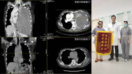 步步惊心！长25厘米、重2.85公斤的罕见巨大胸腔肿瘤被切除