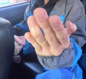 打球戳伤手指，伸直变“小锤”？警惕青少年常见运动伤——锤状指