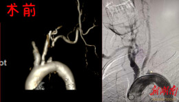 脉搏莫名消失？湘潭市第一人民医院介入微创术让老人脉动“失而复得”