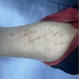 肾病患者皮肤瘙痒难耐？专家支招科学应对