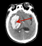 寒冬生死时速！长沙泰和医院神经外科成功救治重症脑出血患者