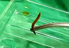 3.5厘米长鱼刺穿肠，险！2小时手术取刺化险为夷