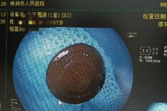 株洲67岁老人误吞“保健磁石”险酿大祸