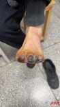 冬季糖友警惕“无痛”烫伤！男子因烤火致足趾发黑流脓