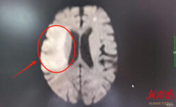 肿瘤患者突发脑梗？微创手术揪出“沉默杀手”特鲁索综合征