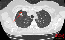 不吸烟也会得肺癌？女性这些防控要点别忽视！