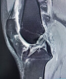 韧带翻修精准施治，郴州市第一人民医院重启患者运动人生