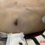 湖南首例！无管麻醉+隐形切口，气胸手术迈入“超微创美学时代”