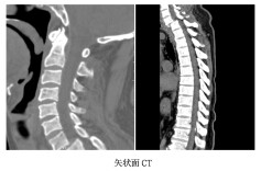 锁骨与胸骨之后：一场在“透视盲区”完成的脊柱复位战