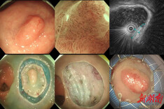肠镜揪出早期癌 微创手术除隐患