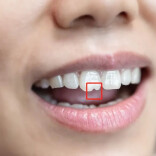 门牙前的“豁”真是嗑瓜子惹的祸？多年来的困惑终于解开了！