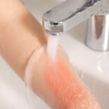 马年春节健康指南㊽｜过节当心这些烫伤”隐患“！要想恢复快、少留疤，这五步少不了